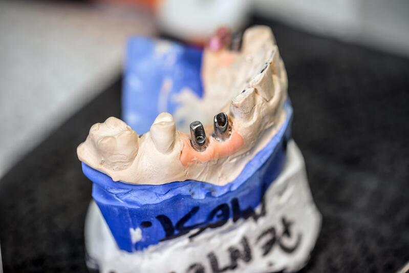 Vis d'un implant dentaire dans un modèle de mâchoire