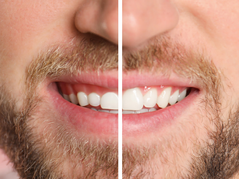 Sonrisa de un hombre mostrando antes y después corrección encías
