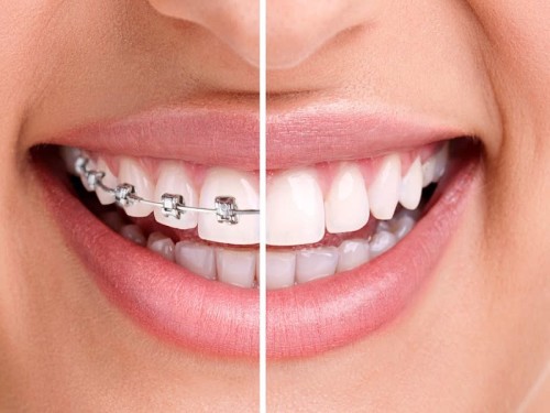 Zahnspangenarten: Feste, lose, linguale, unsichtbare Zahnspange?
