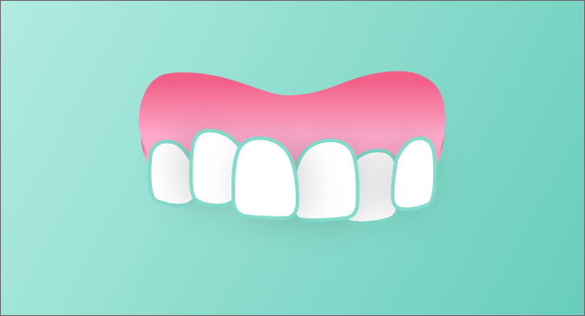 Illustrazione affollamento dentale DR SMILE