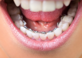 Apparecchio linguale: cos'è? Tipologie, pro e contro, alternative