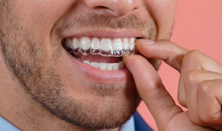 Apparecchio linguale: cos'è? Tipologie, pro e contro, alternative