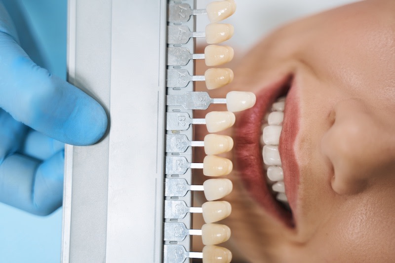 Faccette dentali: il trattamento per un sorriso perfetto