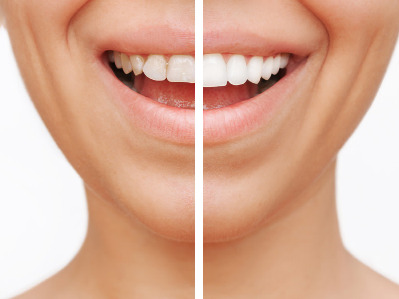 Sonrisa mostrando antes y después con carillas dentales
