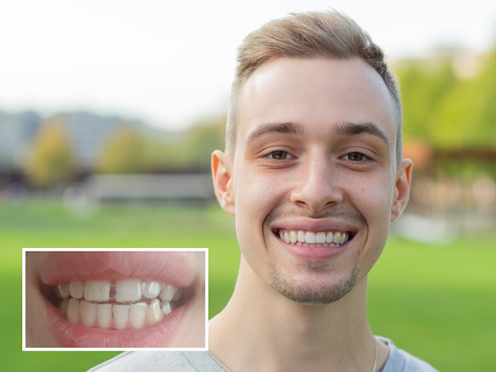 Mann lächelt mit geraderen Zähnen im vorher-nachher Vergleich nach einer Zahnlücke
