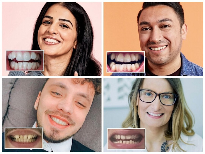 DrSmile Erfahrungen Zahnspange vorher nachher