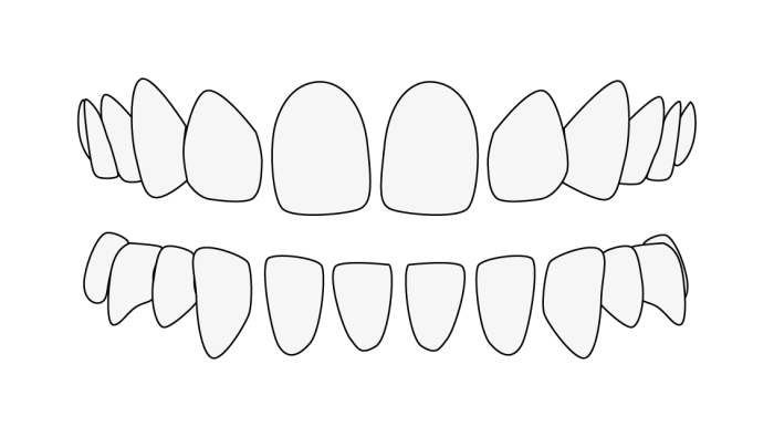 Diastème, ou espacement dentaire