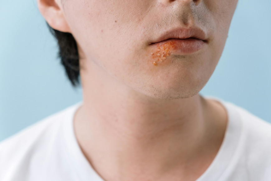Herpes Blaeschen, von pexels via @cottonbro