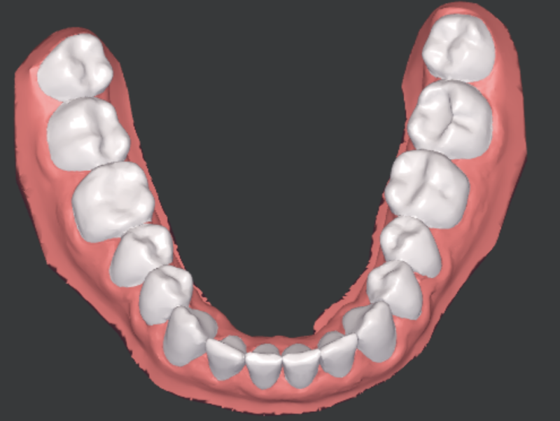 Scanner 3D des dents de la mâchoire inférieure du patient après un traitement par aligneurs lors d'une étude de cas clinique