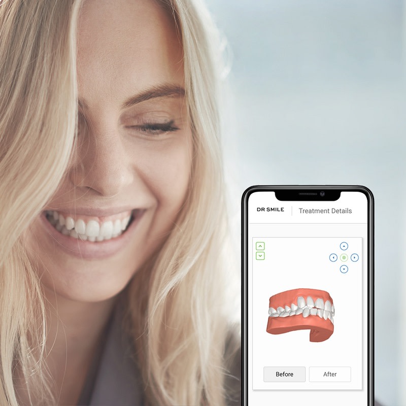 World's first time series study demonstrating the effect of electronic reminders and feedback on patient compliance with clear aligner treatment