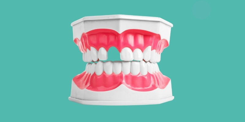 Ilustración de una dentadura sin un diente