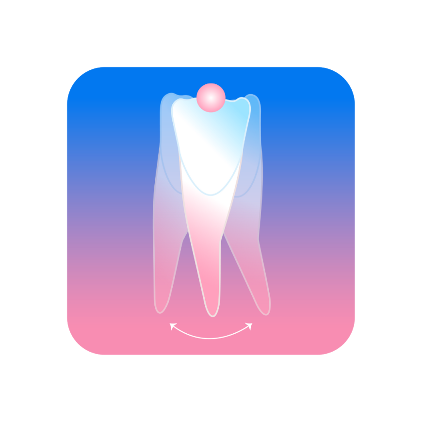 Illustrazione tipping ortodontico della radice