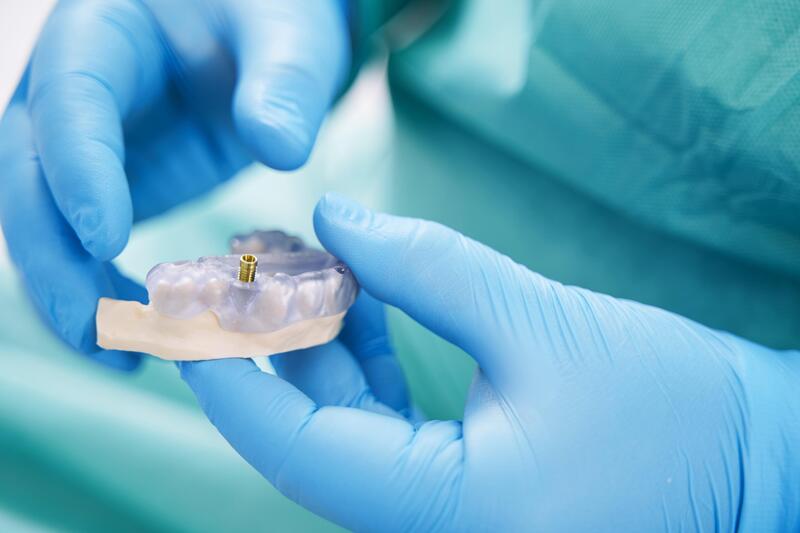 Le guide complet sur les implants dentaires