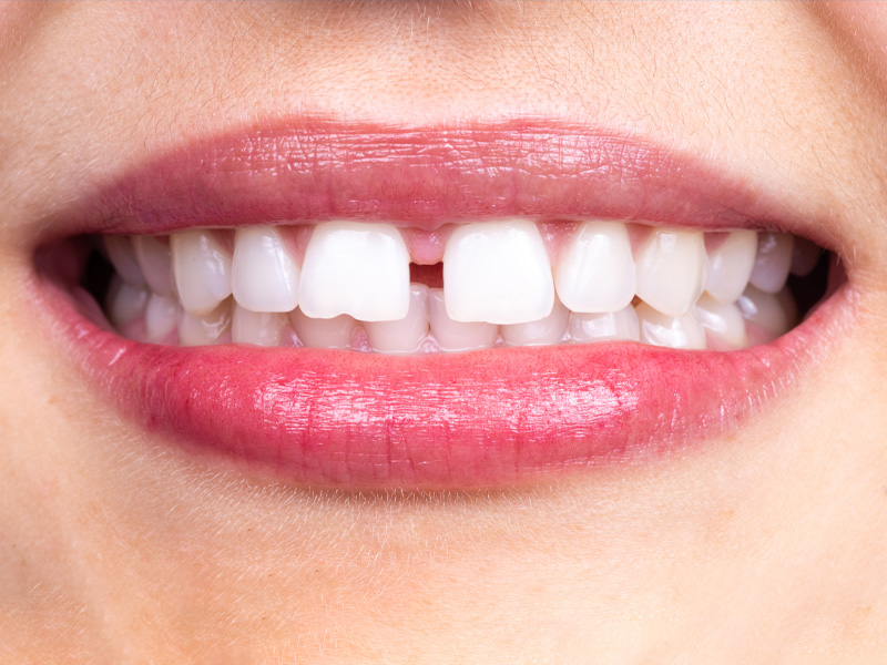 Sonrisa de una chica con diastema o espacio entre los dientes