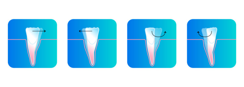 Aligner können die Zähne nach vorn und zurück verschieben sowie rotieren