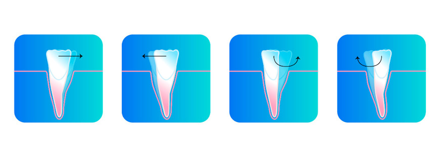 Types de déplacements possibles des dents grâce aux aligneurs dentaires