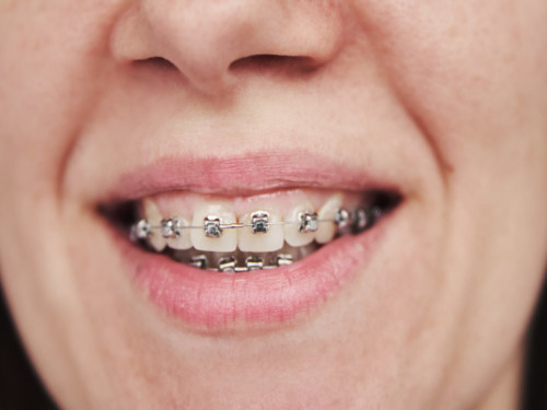 Tipos de Brackets ¿Cuáles Son Los Indicados Para Ti?