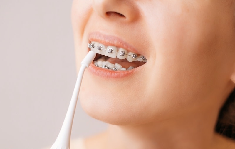 Jet dentaire utilisÃ© pour nettoyer des dents portant un appareil dentaire fixe