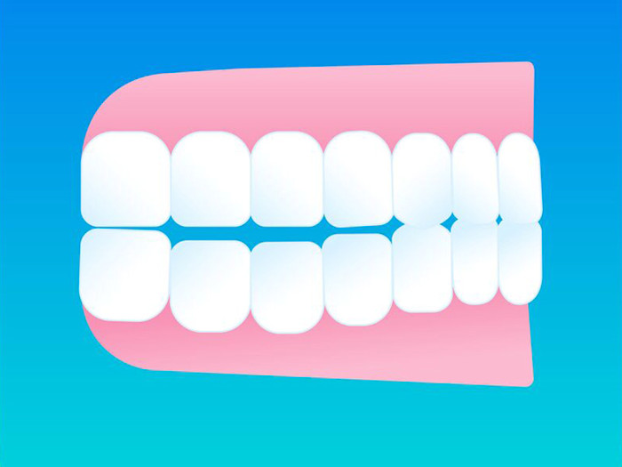 Ilustracion del perfil de mordida abierta