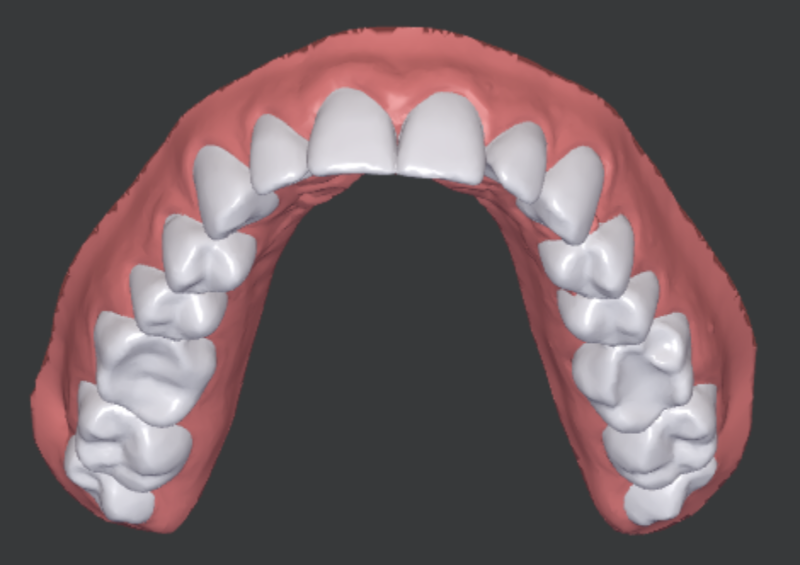 Scanner 3D des dents de la mâchoire supérieure avant le traitement par aligneurs, cas d'étude clinique (homme, 33 ans)