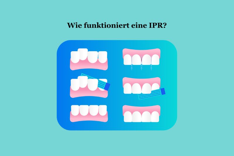 Wie funktioniert eine IPR? 