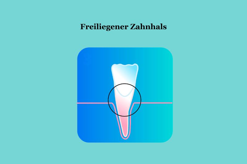 was ist ein freiligender zahnhals?