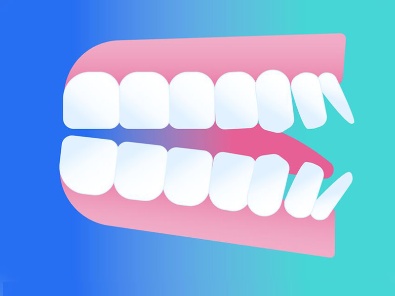 Illustration of an open bite profile (tongue)