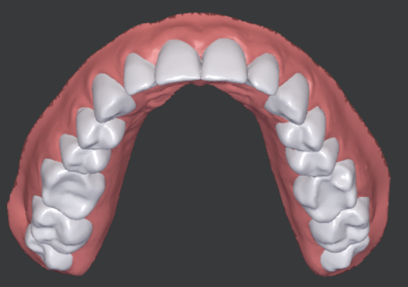 Scanner 3D des dents de la mâchoire supérieure du patient après un traitement par aligneurs lors d'une étude de cas clinique