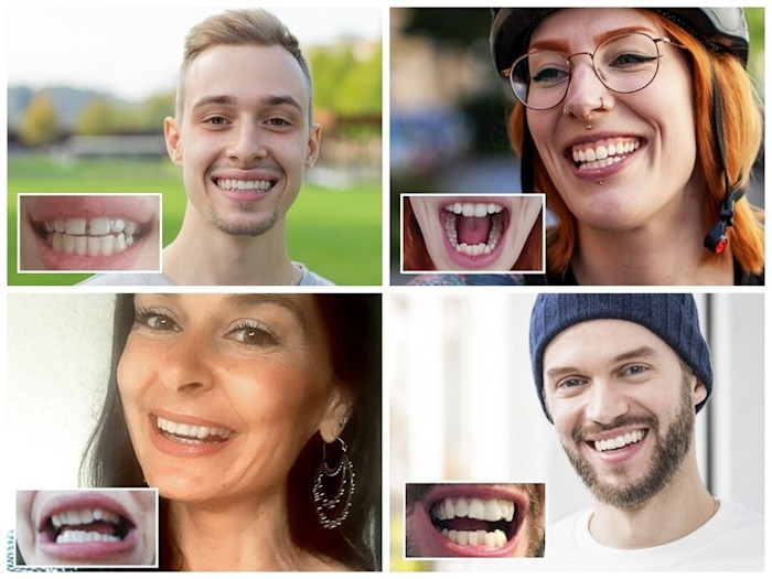 DrSmile Erfahrungen Zahnspange vorher nachher