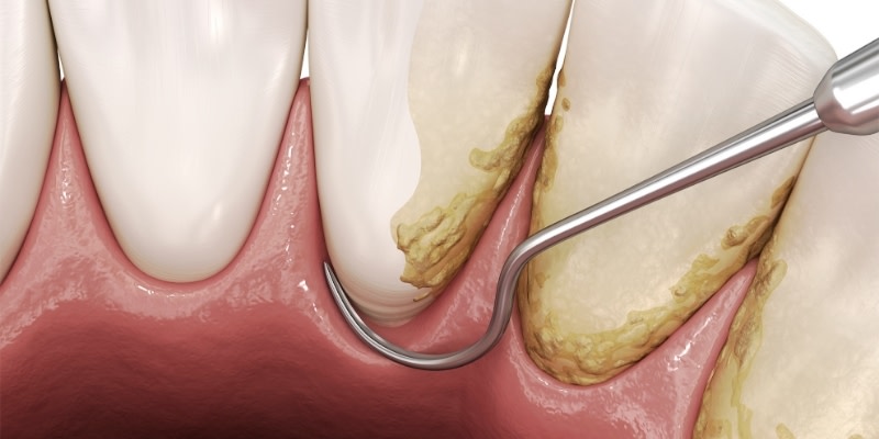 Curettage gengivale: tutto ciò che c’è da sapere