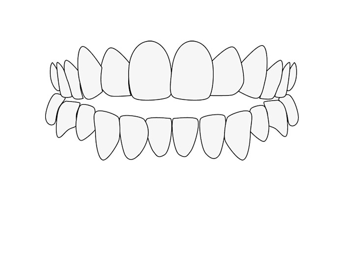 Mordida abierta