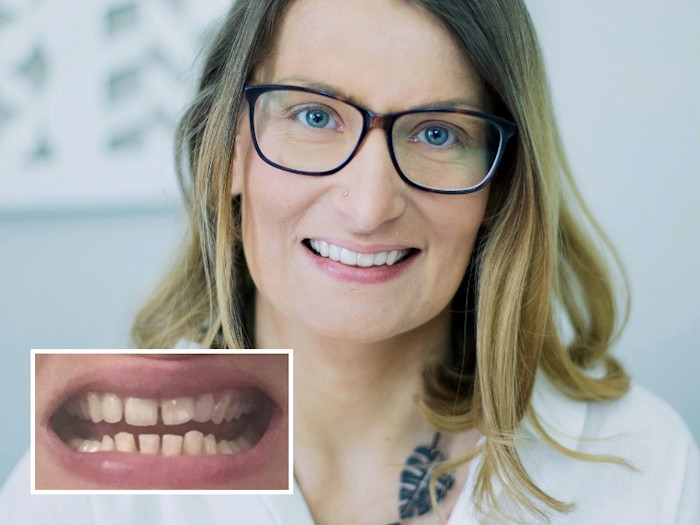 Diastema prima e dopo con apparecchio trasparente 2