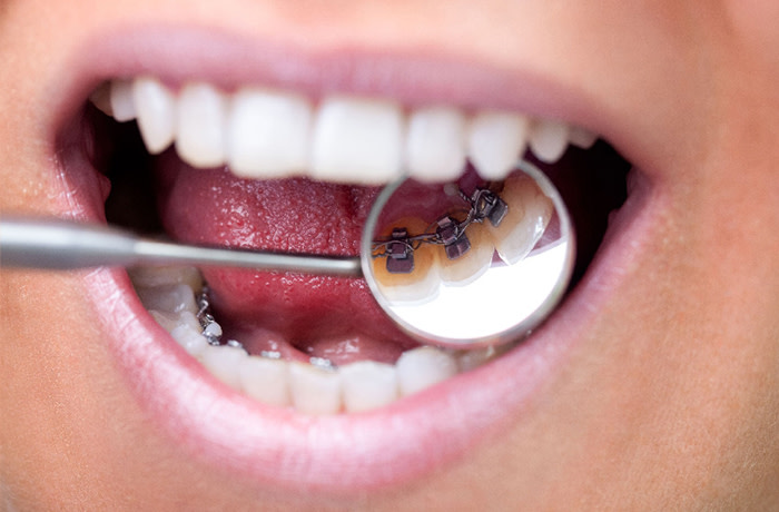 Lingual tandställning