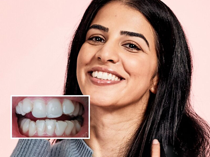 Chica con dientes apiñados