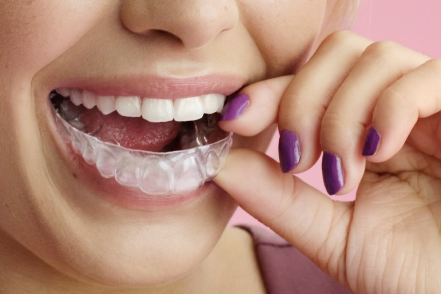 Primer plano de la boca de una persona que se quita los alineadores DR SMILE durante su tratamiento de ortodoncia invisible