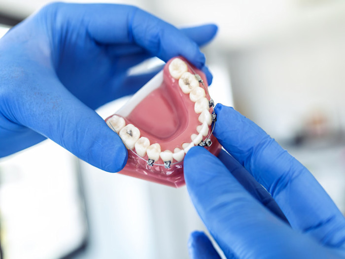 aparato de dientes