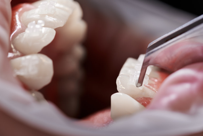 Ataches dentales: su papel en la ortodoncia invisible