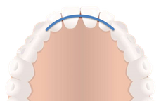 Retainer - Yes