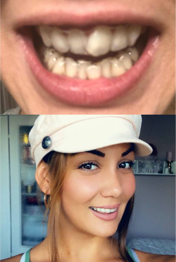 Avant-après encombrement dentaire traitement par aligneurs Aylin