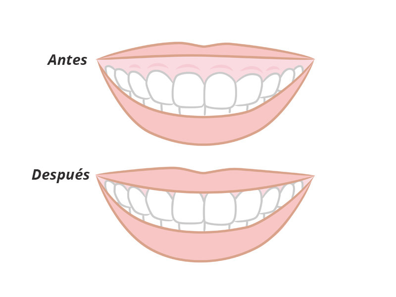 Antes y despues de la sonrisa gingival