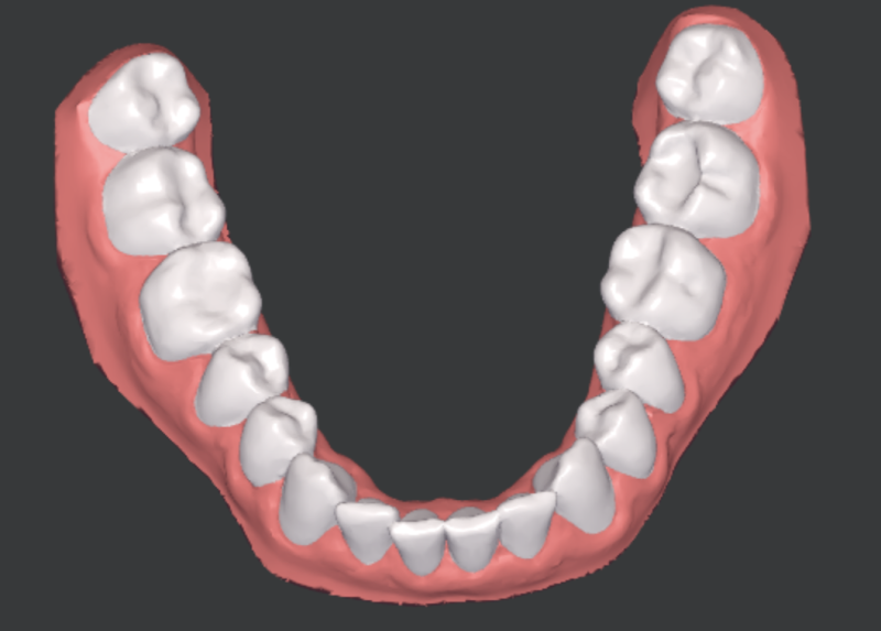 Scanner 3D des dents de la mâchoire inférieure avant le traitement par aligneurs, cas d'étude clinique (homme, 33 ans)
