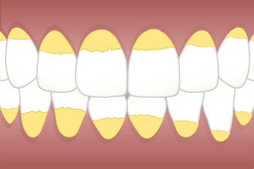 Illustrazione denti con tartaro
