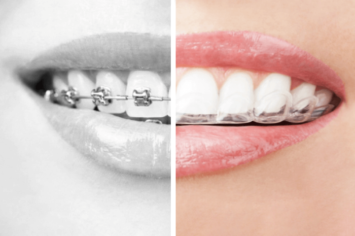 Comparaison bagues en métal et aligneurs dentaires invisibles