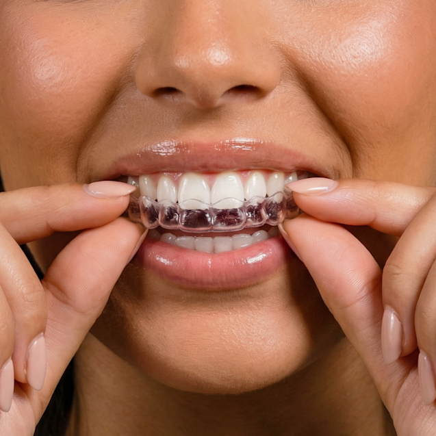 Zahnschienen fr geradere Zhne | DR SMILE Zahnschienen fr geradere Zhne | DR SMILE