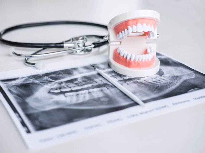 Foto radigrafia stripping dientes