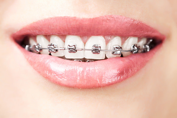 Zahnspangengummis bei Zahnfehlstellungen