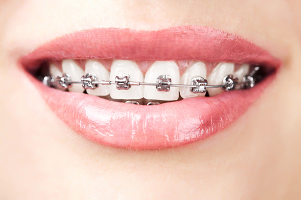 Smile doctors deals braces