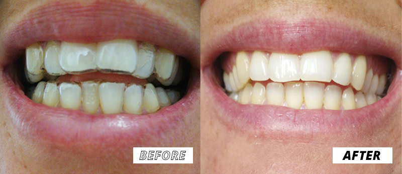 Prima e dopo risultato paziente DR SMILE