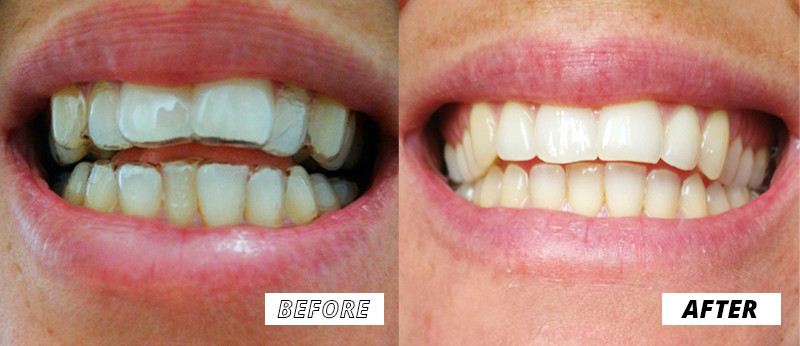 Prima e dopo risultato paziente DR SMILE