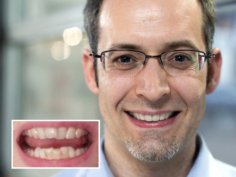 Résultats avant après du port d'aligneurs invisibles DR SMILE sur des dents mal alignées 